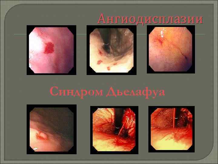 Ангиодисплазии Синдром Дьелафуа 