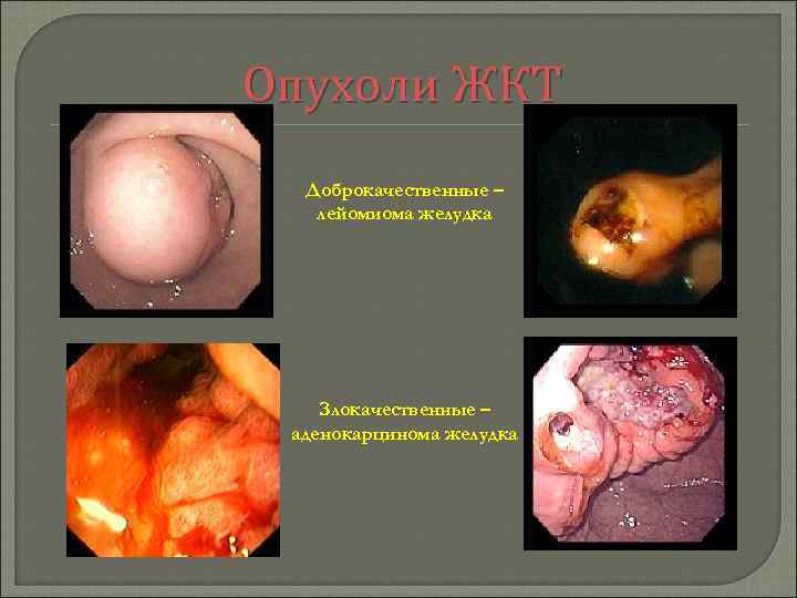 Опухоли ЖКТ Доброкачественные – лейомиома желудка Злокачественные – аденокарцинома желудка 