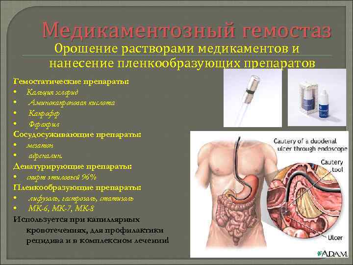 Медикаментозный гемостаз Орошение растворами медикаментов и нанесение пленкообразующих препаратов Гемостатические препараты: • Кальция хлорид