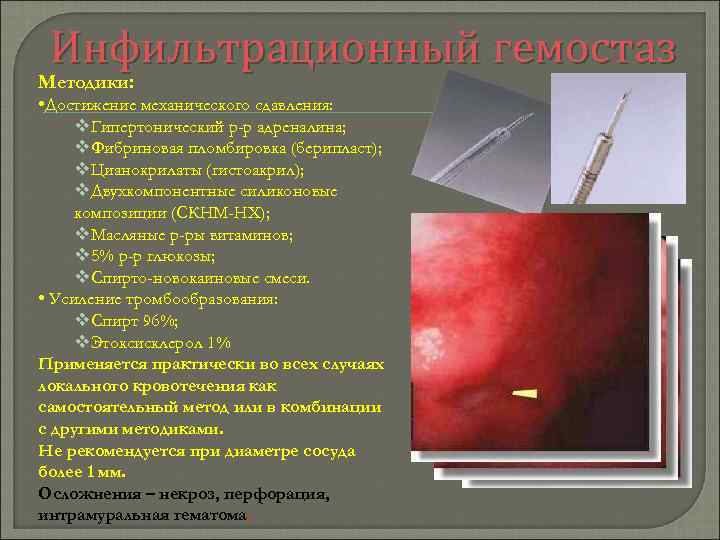 Инфильтрационный гемостаз Методики: • Достижение механического сдавления: v. Гипертонический р-р адреналина; v. Фибриновая пломбировка