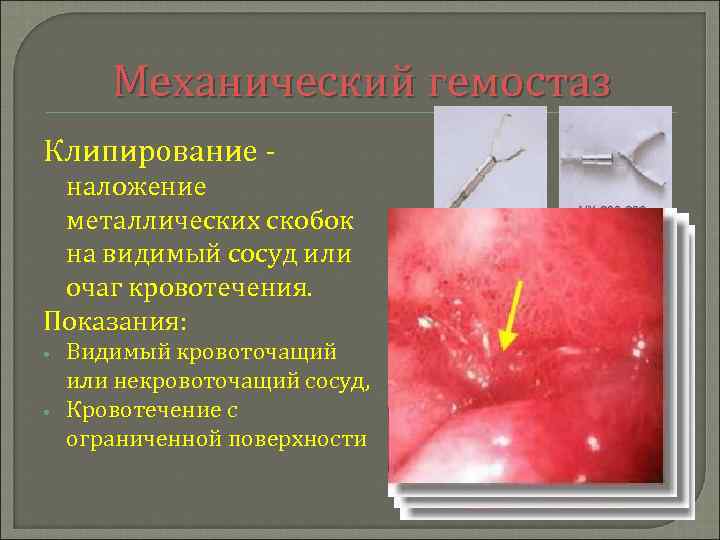 Механический гемостаз Клипирование - наложение металлических скобок на видимый сосуд или очаг кровотечения. Показания: