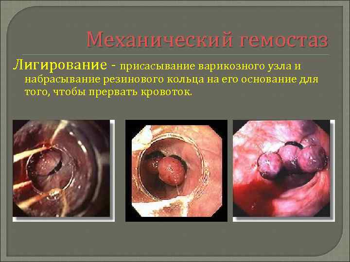 Механический гемостаз Лигирование - присасывание варикозного узла и набрасывание резинового кольца на его основание