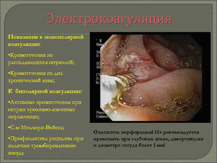 Электрокоагуляция Показания к монополярной коагуляции: • Кровотечения из распадающихся опухолей; • Кровотечения из дна