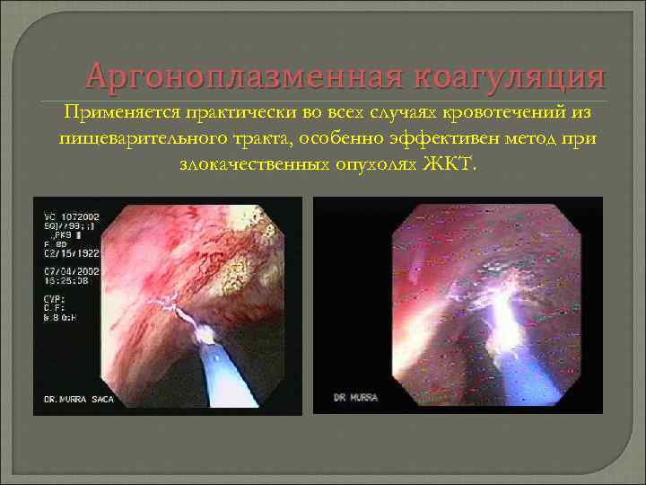 Аргоноплазменная коагуляция Применяется практически во всех случаях кровотечений из пищеварительного тракта, особенно эффективен метод