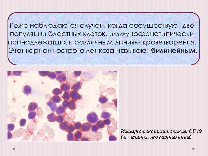Реже наблюдаются случаи, когда сосуществуют две популяции бластных клеток, иммунофенотипически принадлежащих к различным линиям