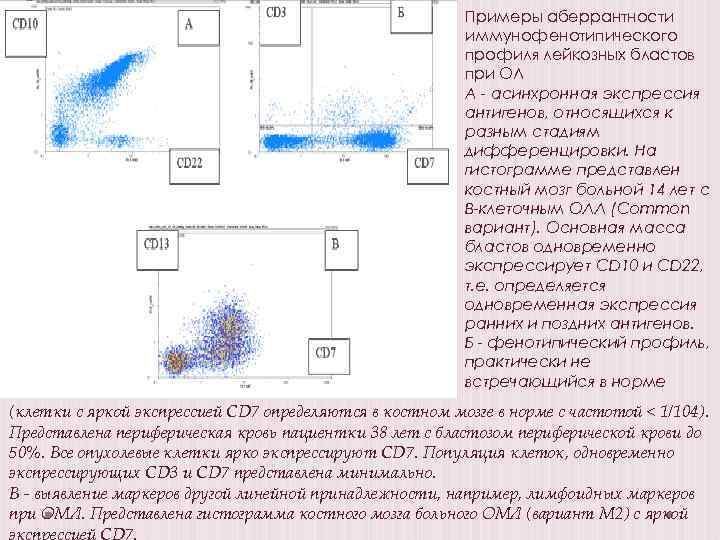 Примеры аберрантности иммунофенотипического профиля лейкозных бластов при ОЛ А - асинхронная экспрессия антигенов, относящихся