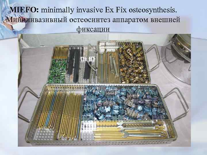 MIEFO: minimally invasive Ex Fix osteosynthesis. Миниинвазивный остеосинтез аппаратом внешней фиксации 