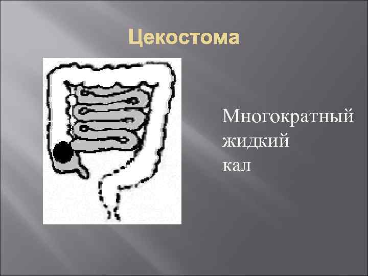 Цекостома Многократный жидкий кал 