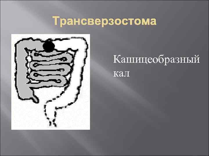 Трансверзостома Кашицеобразный кал 