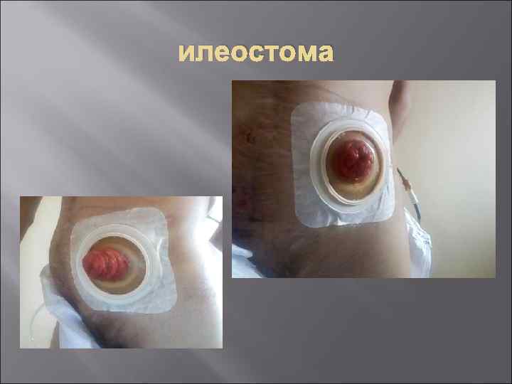 илеостома 