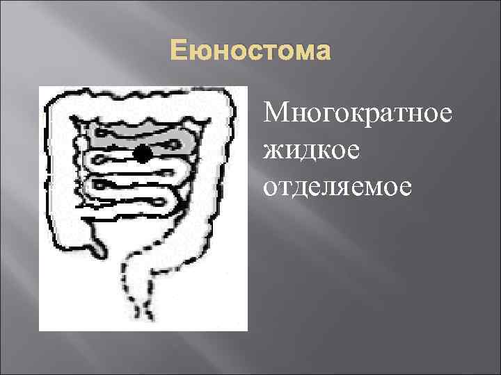 Еюностома Многократное жидкое отделяемое 