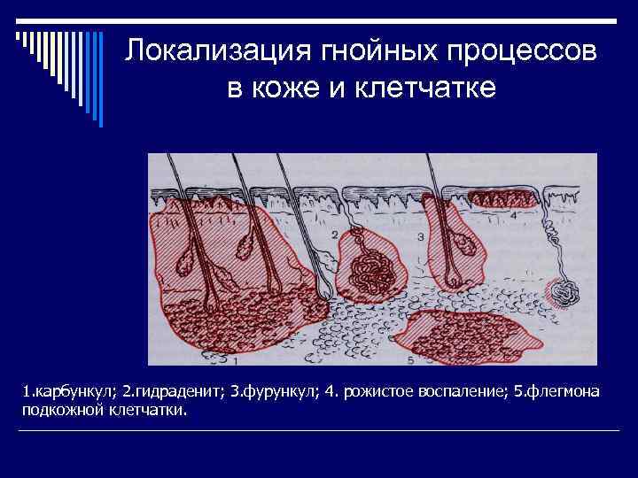 Локализация гнойных процессов в коже и клетчатке 1. карбункул; 2. гидраденит; 3. фурункул; 4.