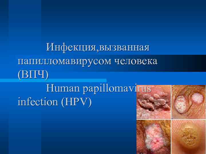Инфекция, вызванная папилломавирусом человека (ВПЧ) Human papillomavirus infection (HPV) 