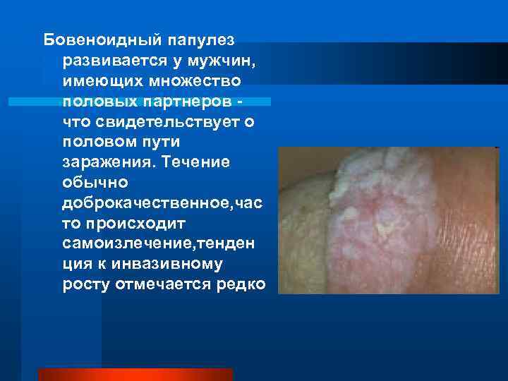 Бовеноидный папулез развивается у мужчин, имеющих множество половых партнеров - что свидетельствует о половом