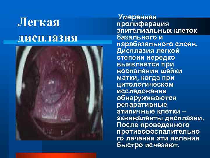 Легкая дисплазия Умеренная пролиферация эпителиальных клеток базального и парабазального слоев. Дисплазия легкой степени нередко