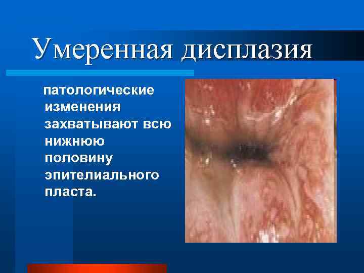 Умеренная дисплазия патологические изменения захватывают всю нижнюю половину эпителиального пласта. 