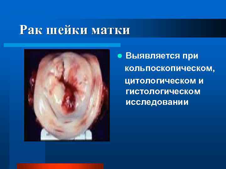 Рак шейки матки Выявляется при кольпоскопическом, цитологическом и гистологическом исследовании l 
