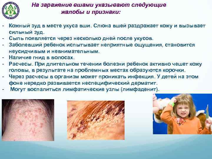 На заражение вшами указывают следующие жалобы и признаки: - Кожный зуд в месте укуса