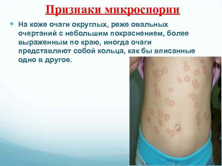 Признаки микроспории На коже очаги округлых, реже овальных очертаний с небольшим покраснением, более выраженным