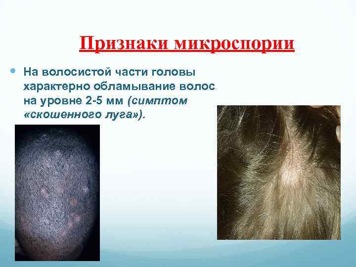 Признаки микроспории На волосистой части головы характерно обламывание волос на уровне 2 -5 мм