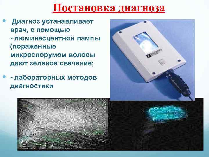 Постановка диагноза Диагноз устанавливает врач, с помощью - люминесцентной лампы (пораженные микроспорумом волосы дают