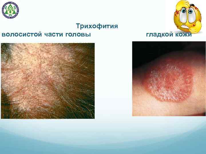  Трихофития волосистой части головы гладкой кожи 