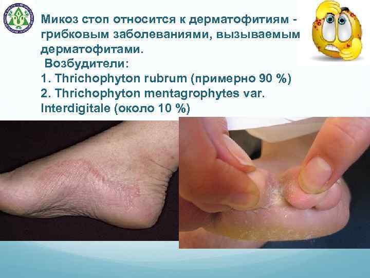 Микоз стоп относится к дерматофитиям - грибковым заболеваниями, вызываемым дерматофитами. Возбудители: 1. Thrichophyton rubrum