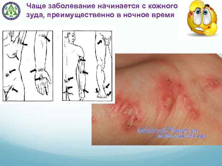 Чаще заболевание начинается с кожного зуда, преимущественно в ночное время 