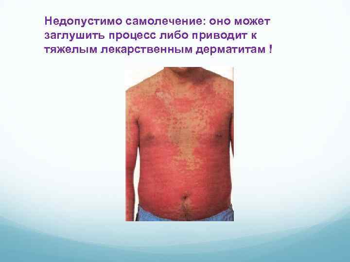 Недопустимо самолечение: оно может заглушить процесс либо приводит к тяжелым лекарственным дерматитам ! 
