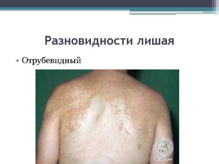 Разновидности лишая • Отрубевидный 