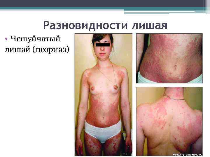 Разновидности лишая • Чешуйчатый лишай (псориаз) 