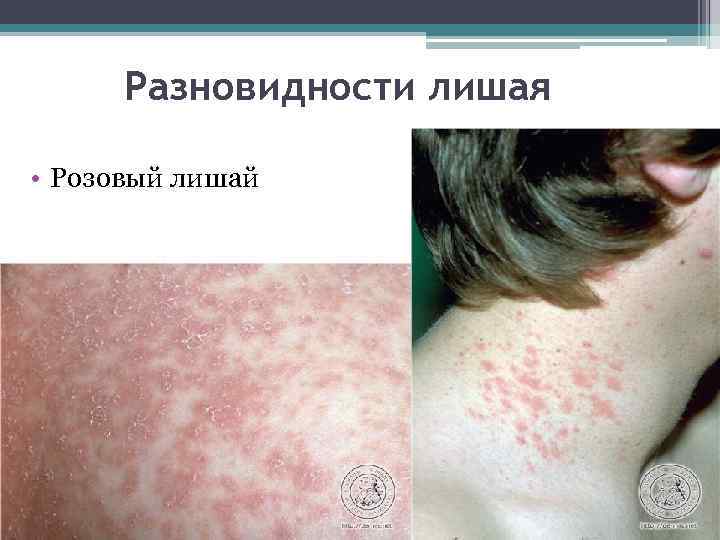 Разновидности лишая • Розовый лишай 