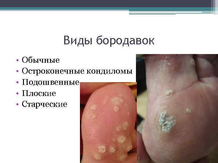 Виды бородавок • • • Обычные Остроконечные кондиломы Подошвенные Плоские Старческие 