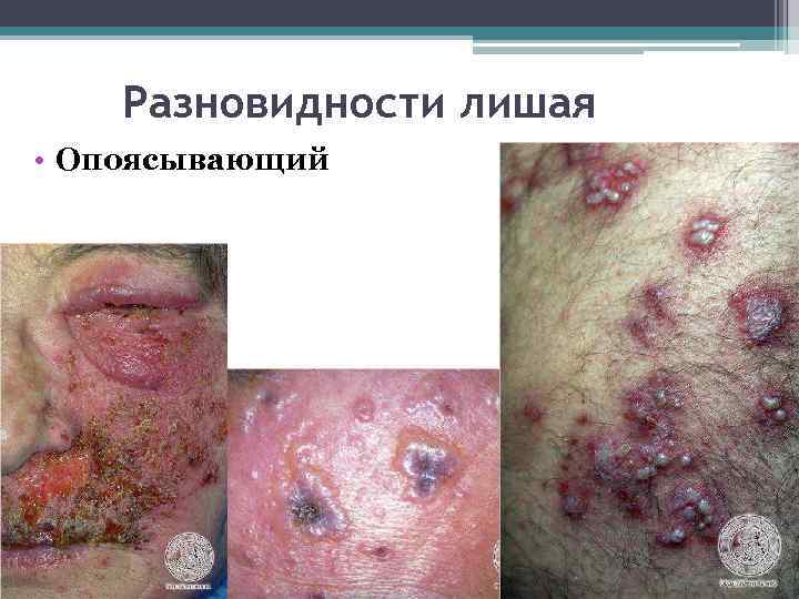 Разновидности лишая • Опоясывающий 