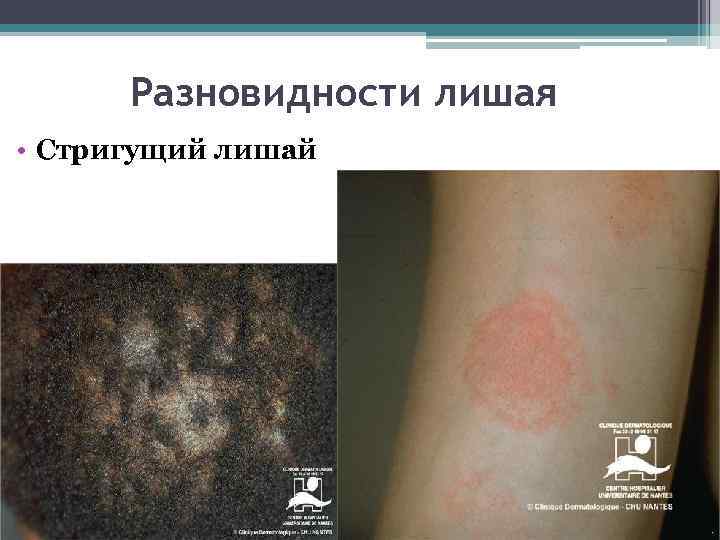 Разновидности лишая • Стригущий лишай 