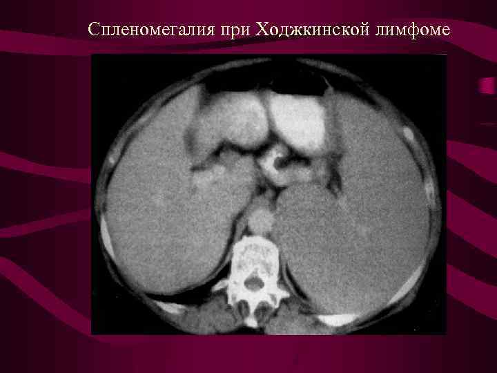 Кт картина спленомегалии