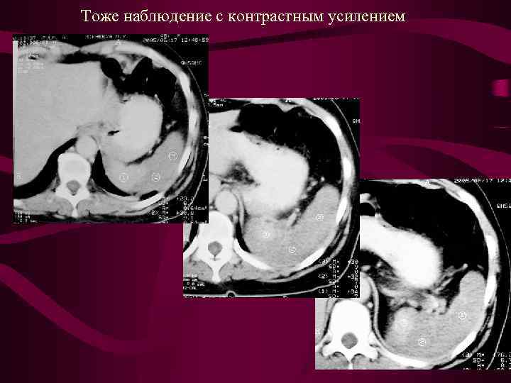 Тоже наблюдение с контрастным усилением 