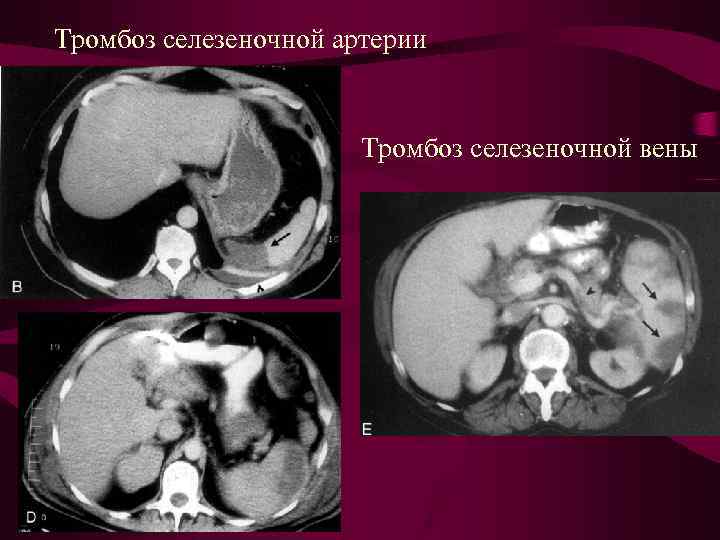 Тромбоз селезеночной артерии Тромбоз селезеночной вены 