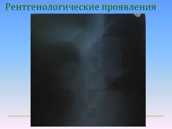 Рентгенологические проявления 