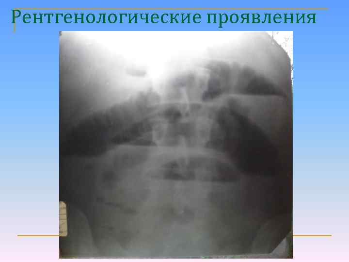 Рентгенологические проявления 