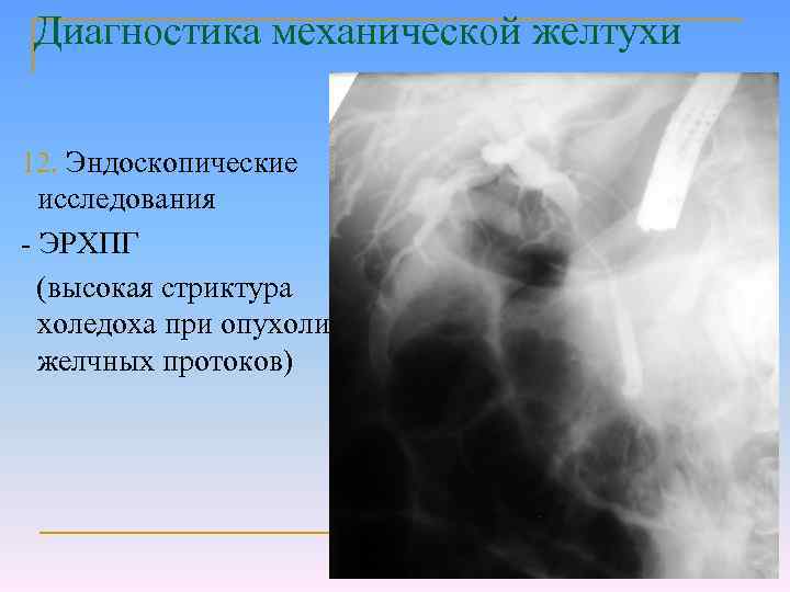 Диагностика механической желтухи 12. Эндоскопические исследования - ЭРХПГ (высокая стриктура холедоха при опухоли желчных