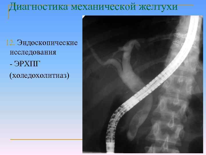 Холедохолитиаз факультетская хирургия презентация