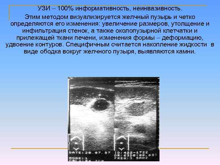 УЗИ – 100% информативность, неинвазивность. Этим методом визуализируется желчный пузырь и четко определяются его