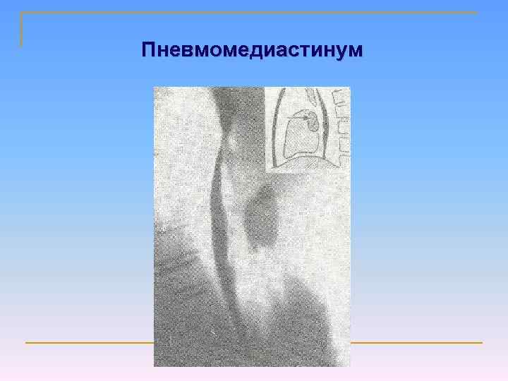Пневмомедиастинум 