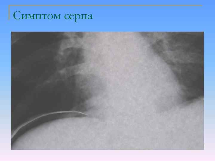 Симптом серпа 