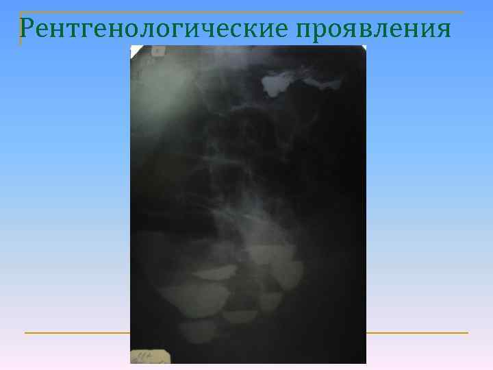 Рентгенологические проявления 