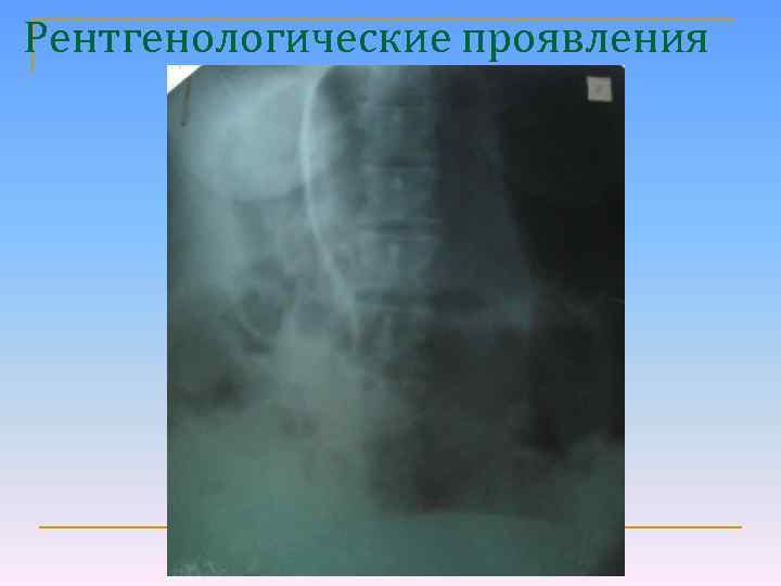 Рентгенологические проявления 