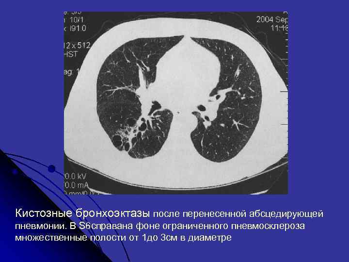 Кистозные бронхоэктазы после перенесенной абсцедирующей пневмонии. В S 6 справана фоне ограниченного пневмосклероза множественные