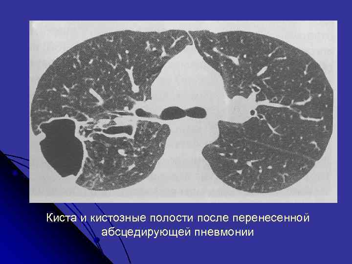 Киста и кистозные полости после перенесенной абсцедирующей пневмонии 