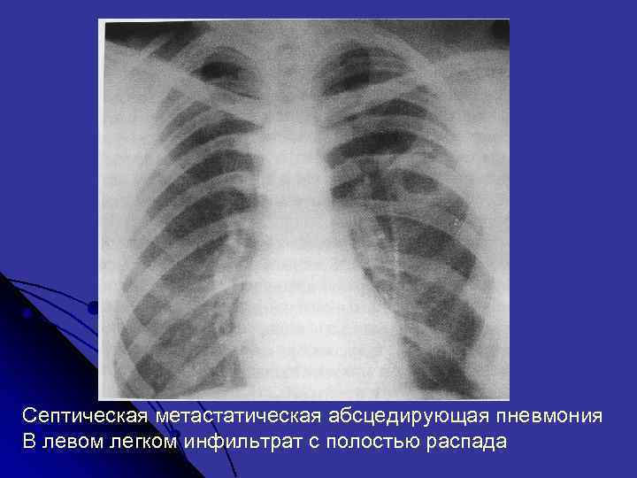 Септическая метастатическая абсцедирующая пневмония В левом легком инфильтрат с полостью распада 